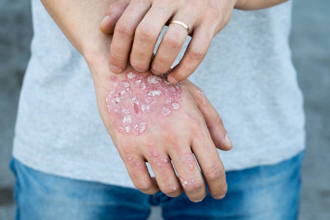 CBD et psoriasis